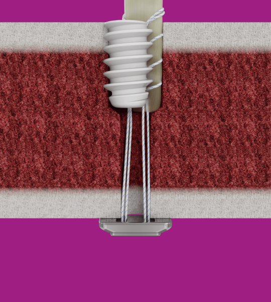 Introducing the TenoTrap<sup>™</sup> Screw System Image