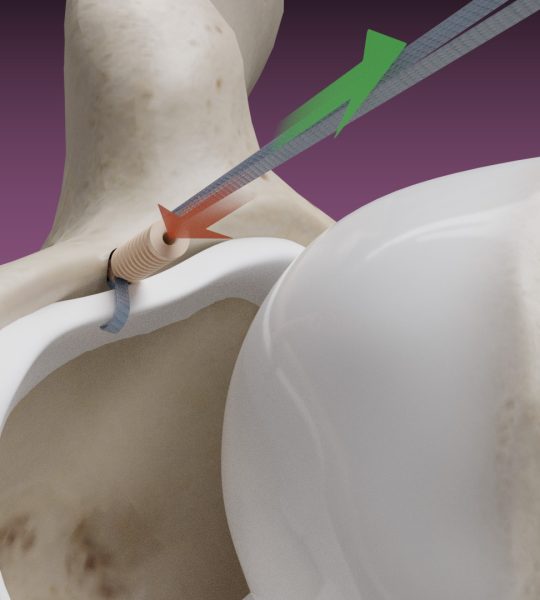 Dunamis Medical<sup>®</sup> announces FDA clearance of its TensionTac<sup>™</sup> Image